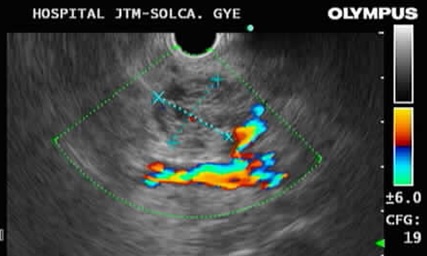 Imagen ecográfica del Tumor Mucinoso Papilar Intra Ductal del Páncreas
